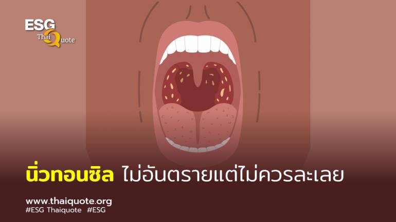 นิ่วทอนซิลสาเหตุเกิดจากการดูแลความสะอาดช่องปากไม่เพียงพอ